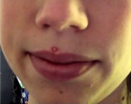 Pimple Around Mouth