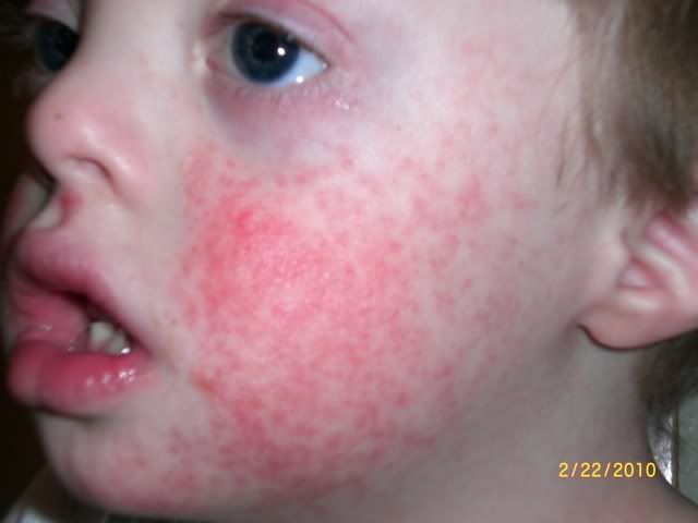 allergic reaction rash. an allergic reaction rash.